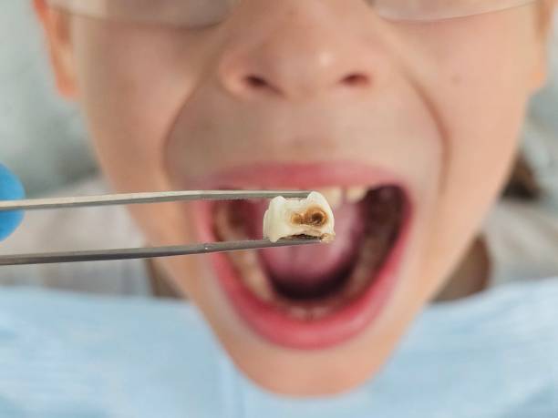 Best Emergency Dental Care for Broken or Chipped Teeth in Hurleyville, NY